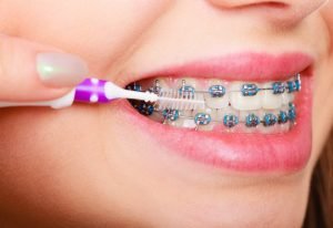 Perawatan Sederhana Setelah Pasang Kawat Gigi