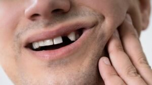 Rahasia Gigi Ompong di Usia Muda: Ini Kata Dokter Gigi dan Hasil Studi Terbaru