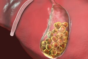 2.000 Batu Empedu Dikeluarkan: Operasi Menakjubkan Dokter China yang Gegerkan Dunia Medis